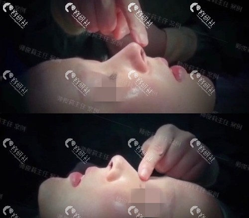 西安国医中心整形外科师俊莉隆鼻术后即刻效果
