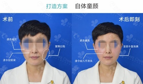 成都做面部提升抗衰技术好的医生刘小娇提升日记