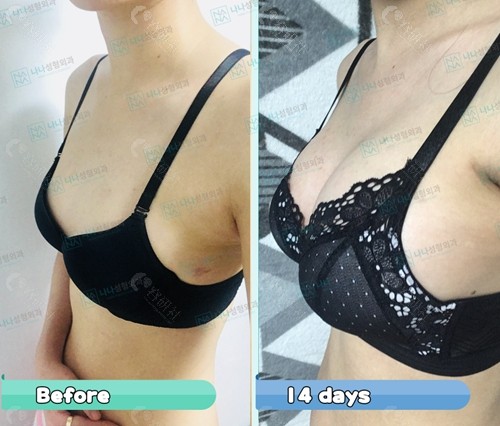 韩国NANA整形外科假体隆胸前后效果对比