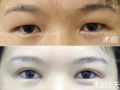 北京丰联丽格师丽丽割双眼皮前后对比图
