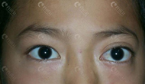 近视眼突眼能通过激光治疗改变吗