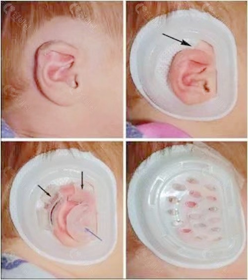佩戴耳模无创矫治器治疗宝宝耳廓畸形过程
