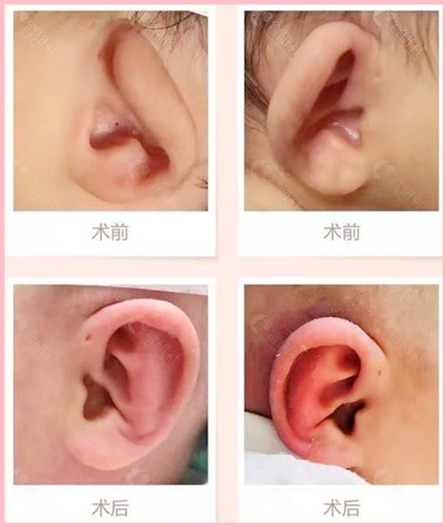 新生儿耳廓畸形早期干预矫正术前术后对比图