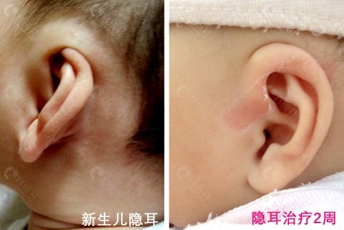 新生儿隐耳耳模无创矫治2周后对比图