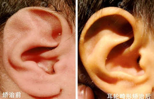 耳模无创矫治耳轮畸形前后对比图