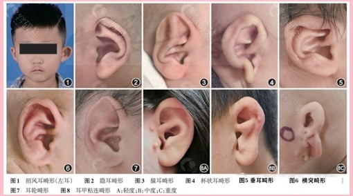 耳模无创矫治可以治疗的耳廓形态畸形