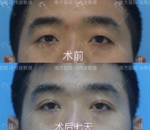 广州南方医科大学南方医院冯传波割双眼皮真人案例