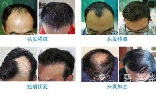 深圳碧莲盛植发男士发际线种植前后对比