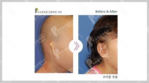 韩国普罗菲耳耳畸形矫正前后效果对比