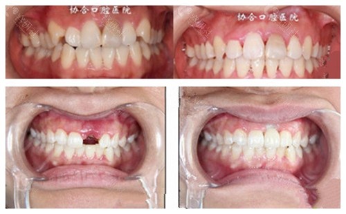 衡阳协合口腔牙齿矫正，种植牙案例