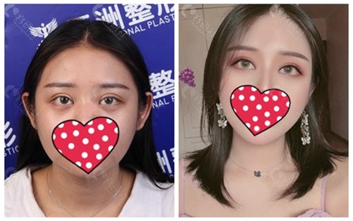 武汉五洲莱美双眼皮修复案例