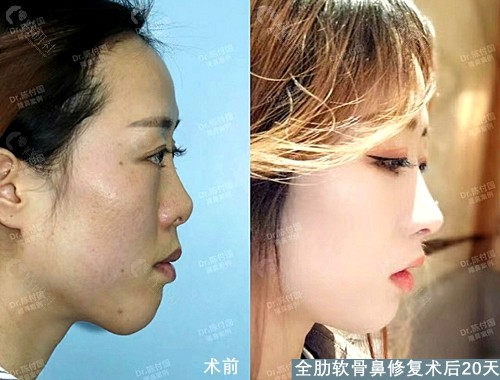 上海九院陈付国全肋软骨鼻修复术前术后20天案例