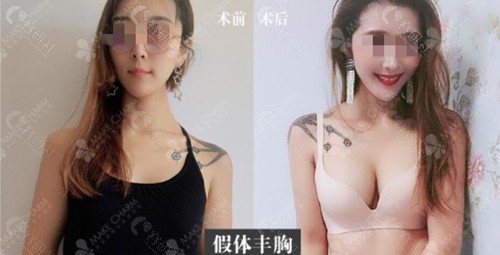 成都美绽美何一波假体隆胸前后对比图