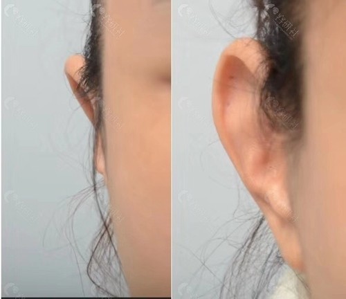 韩国profile普罗菲耳整形外科贴发耳矫正真人日记