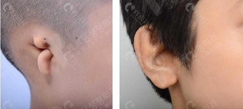 韩国普罗菲耳整形医院耳畸形矫正病例