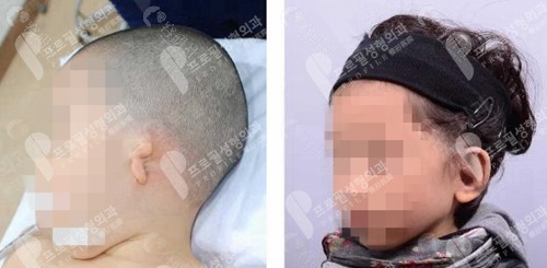 profile普罗菲耳耳部再造术前后对比