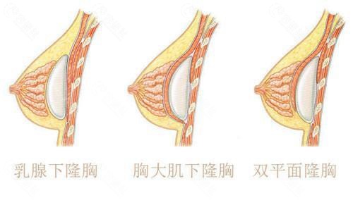 假体隆胸植入位置