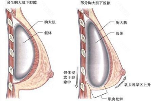 假体隆胸双平面植入
