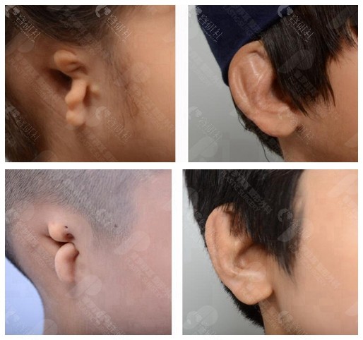 韩国普罗菲耳整形外科郑在皓耳再造案例前后对比
