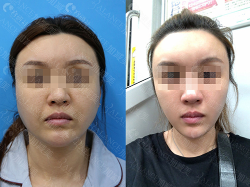 北京加减美面部提升前后对比照