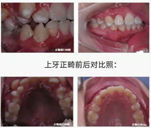 汉中小虎牙口腔牙齿矫正日记