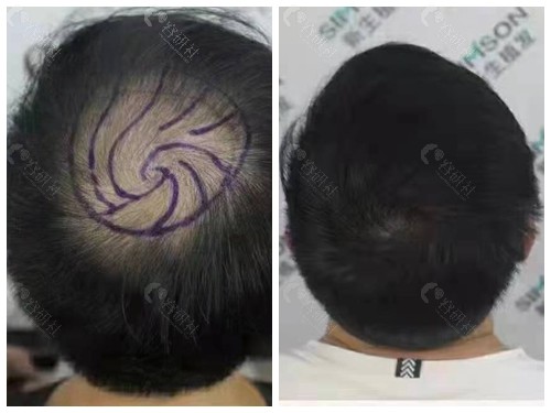 武汉新生植发头顶加密种植前后对比