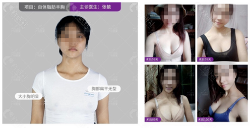广州美莱医疗美容假体隆胸真人案例对比图