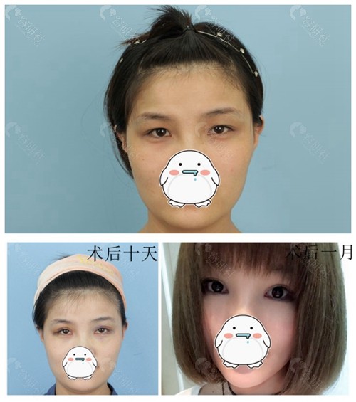 济南艺星医疗美容医院做双眼皮案例前后对比