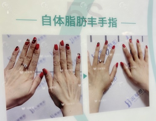 北京东方和谐医疗美容冯斌自体脂肪丰手指前后对比图