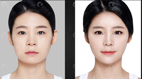 在韩国必当归打瘦脸针前后对比照片