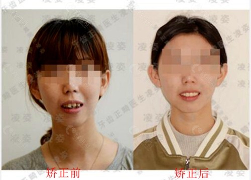 上海圣贝口腔医院牙齿矫正真人日记前后对比图