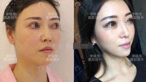 北京东方瑞丽医疗美容门诊部李晓东医生面部提升前后效果对比