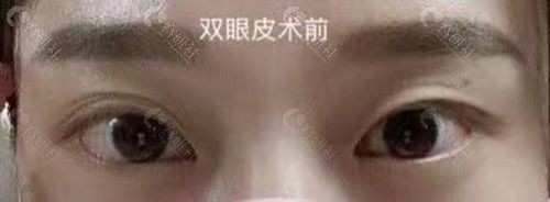 北京联合丽格医院双眼皮术前
