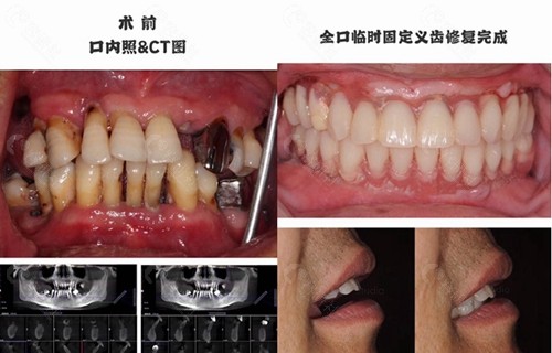 杭州口腔医院种植牙日记