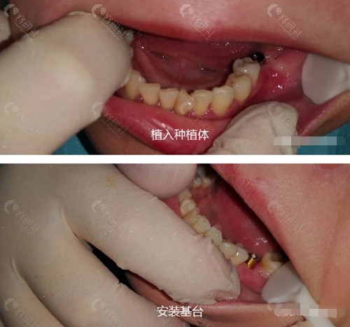 杭州雅莱口腔种植牙过程