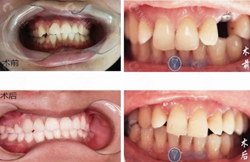 福建三明美达口腔牙齿矫正、种植牙真人<span style=