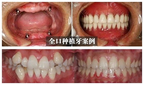 十堰仁美口腔种植牙与牙齿矫正案例