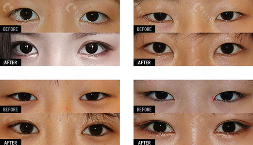韩国爱护整形医院眼部整形前后对比