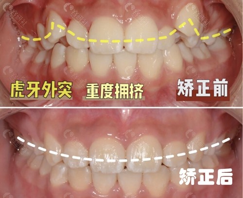 芜湖排名前十牙科医院做的牙齿矫正前后对比图