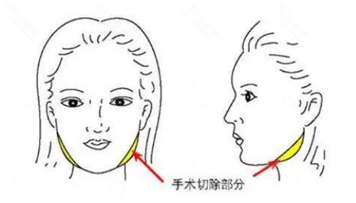 做完下颌角截骨手术后脸一定会下垂吗