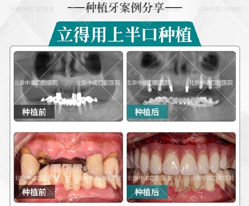 北京中诺口腔种植牙案例