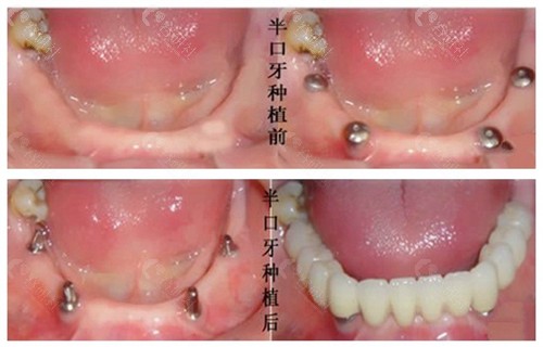 南京美奥口腔半口种植牙日记前后对比