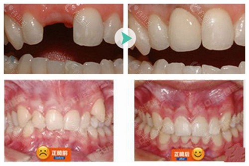 南京博韵口腔牙齿矫正和种植牙日记分享
