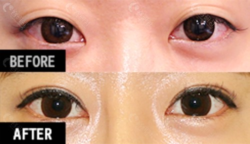 韩国EH爱护医院朴炳浩医生双眼皮宽改窄对比图
