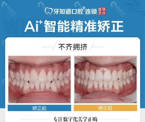 淮安牙知道口腔正畸日记