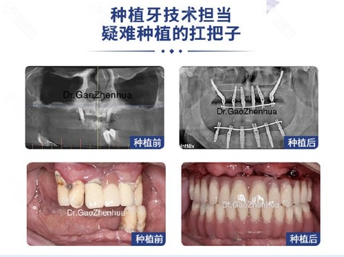 绍兴柯桥牙科种植牙日记