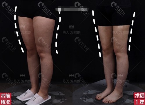 北京联合丽格陈万芳大小腿吸脂案例