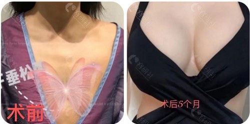 韩国珠儿丽胸部修复手术术前术后对比