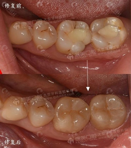 钦州康美口腔牙齿修复前后对比
