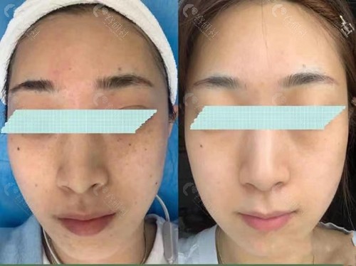 杭州艺星医疗美容医院超皮秒祛斑图片